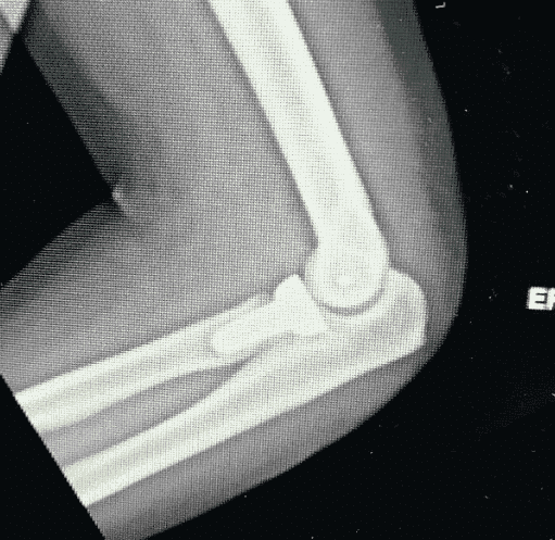 Fractures From Car Accidents