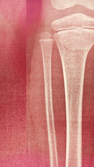 How Do Insurance Companies Calculate Pain And Suffering?
