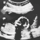 Car Accident While Pregnant