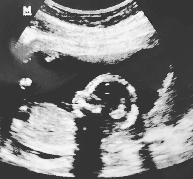 In A Car Accident While Pregnant
