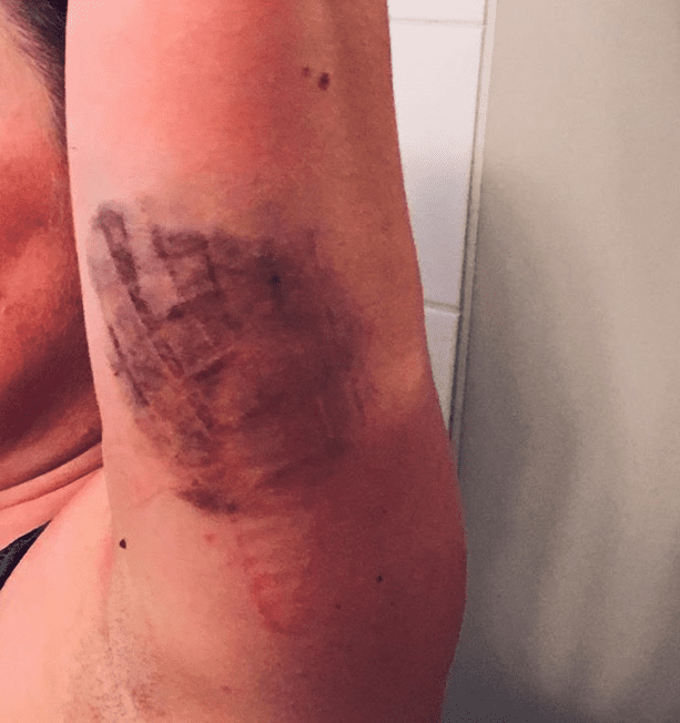 Contusions From Car Accidents